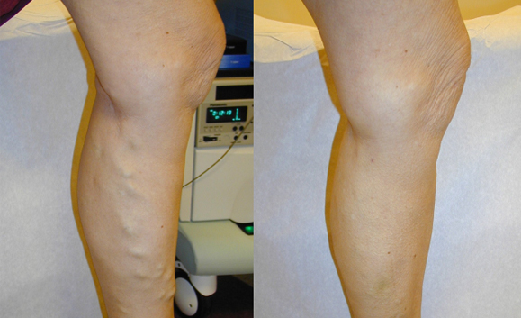 Varicose Vein Treatment in Arlington, TX