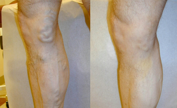 Varicose Veins  Vein Specialists of Augusta