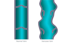 varicose veins